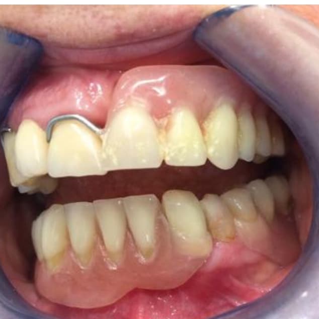 Cliente soddisfatto con protesi flessibile