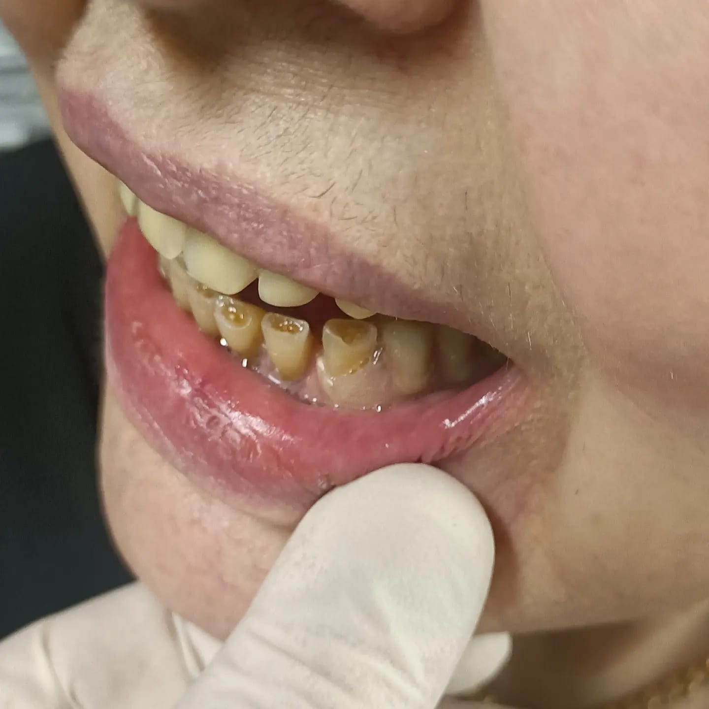 Cliente soddisfatto con protesi mobili