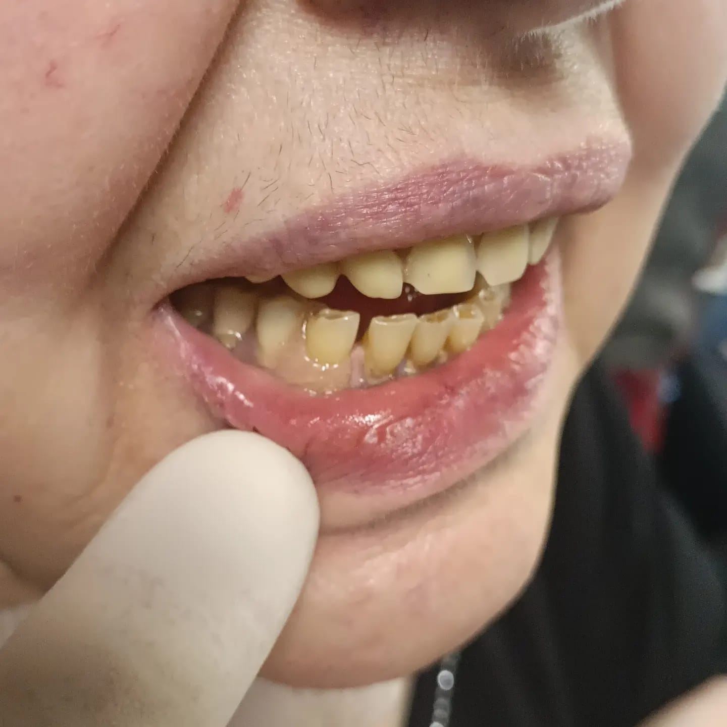 Cliente soddisfatto con protesi fisse